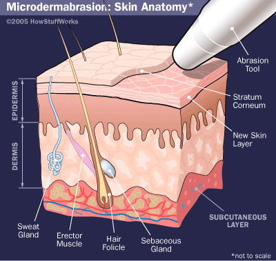 Dr.Houshidari-Microdermabrasion 