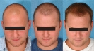 Hair Transplantation