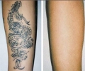 Laser Tattoo Removal