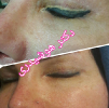 Laser Tattoo Removal-F.Houshidari,MD_10