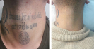 Laser Tattoo Removal
