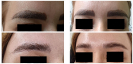 Laser Tattoo Removal-F.Houshidari,MD_15