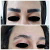 Laser Tattoo Removal-F.Houshidari,MD_19