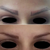 Laser Tattoo Removal-F.Houshidari,MD_1