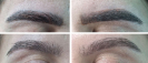 Laser Tattoo Removal-F.Houshidari,MD_1