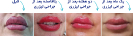 Laser Tattoo Removal-F.Houshidari,MD_20