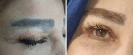 Laser Tattoo Removal-F.Houshidari,MD_21