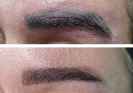 Laser Tattoo Removal-F.Houshidari,MD_24