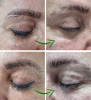 Laser Tattoo Removal-F.Houshidari,MD_25
