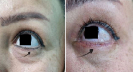 Laser Tattoo Removal-F.Houshidari,MD_26