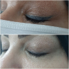 Laser Tattoo Removal-F.Houshidari,MD_27