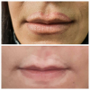 Laser Tattoo Removal-F.Houshidari,MD_28