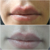 Laser Tattoo Removal-F.Houshidari,MD_29