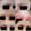 Laser Tattoo Removal-F.Houshidari,MD_31