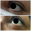 Laser Tattoo Removal-F.Houshidari,MD_32