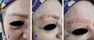 Laser Tattoo Removal-F.Houshidari,MD_33