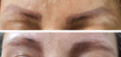 Laser Tattoo Removal-F.Houshidari,MD_34