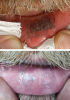 Laser Tattoo Removal-F.Houshidari,MD_35