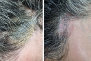 Laser Tattoo Removal-F.Houshidari,MD_36