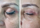 Laser Tattoo Removal-F.Houshidari,MD_37