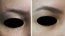 Laser Tattoo Removal-F.Houshidari,MD_38