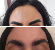 Laser Tattoo Removal-F.Houshidari,MD_3
