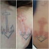 Laser Tattoo Removal-F.Houshidari,MD_42