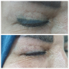 Laser Tattoo Removal-F.Houshidari,MD_43