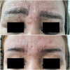 Laser Tattoo Removal-F.Houshidari,MD_45