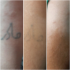 Laser Tattoo Removal-F.Houshidari,MD_46