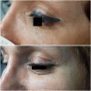 Laser Tattoo Removal-F.Houshidari,MD_48
