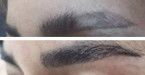 Laser Tattoo Removal-F.Houshidari,MD_4