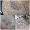 Laser Tattoo Removal-F.Houshidari,MD_50