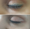 Laser Tattoo Removal-F.Houshidari,MD_51
