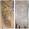 Laser Tattoo Removal-F.Houshidari,MD_52