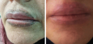 Laser Tattoo Removal-F.Houshidari,MD_53