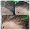 Laser Tattoo Removal-F.Houshidari,MD_54