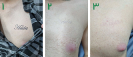 Laser Tattoo Removal-F.Houshidari,MD_55