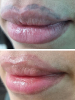 Laser Tattoo Removal-F.Houshidari,MD_56