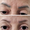 Laser Tattoo Removal-F.Houshidari,MD_57