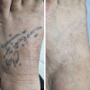 Laser Tattoo Removal-F.Houshidari,MD_58