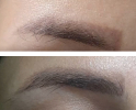 Laser Tattoo Removal-F.Houshidari,MD_5