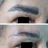 Laser Tattoo Removal-F.Houshidari,MD_60