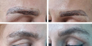 Laser Tattoo Removal-F.Houshidari,MD_61