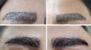Laser Tattoo Removal-F.Houshidari,MD_62