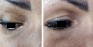 Laser Tattoo Removal-F.Houshidari,MD_65
