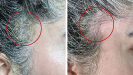 Laser Tattoo Removal-F.Houshidari,MD_67