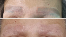 Laser Tattoo Removal-F.Houshidari,MD_68