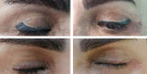Laser Tattoo Removal-F.Houshidari,MD_69