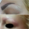 Laser Tattoo Removal-F.Houshidari,MD_6